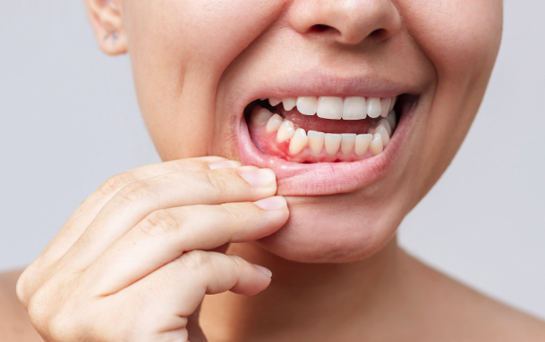 gigi tumbuh di gusi atas